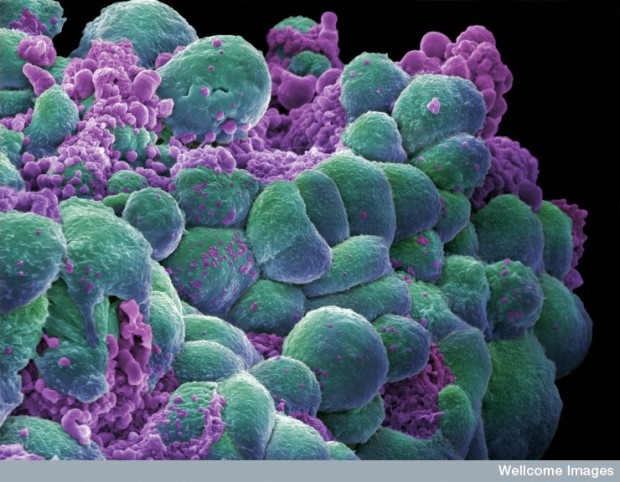 Breast Cancer Cells - false color scanning electron micrograph